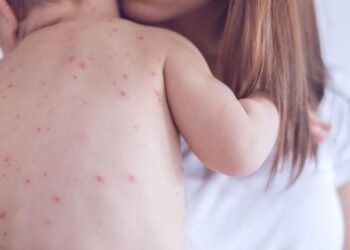Un caso di morbillo