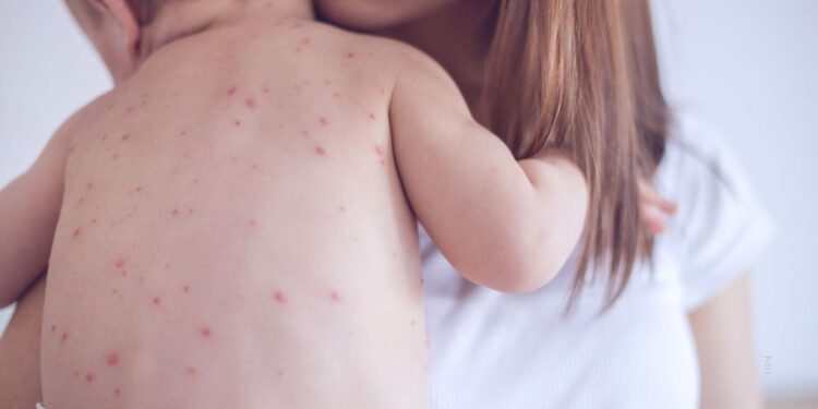 Un caso di morbillo