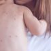 Un caso di morbillo